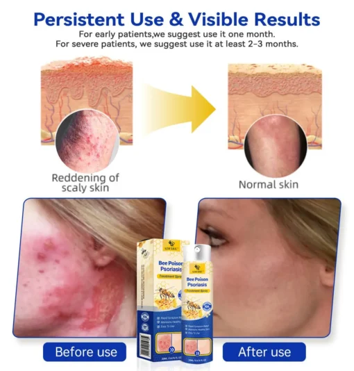 ADFIRE™ PsoriaHeal Bee poison Psoriasis Spray