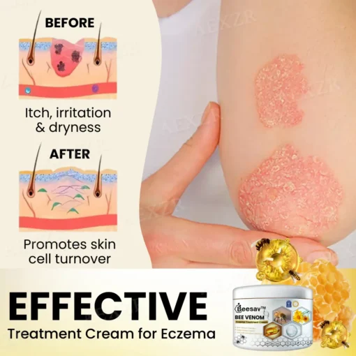 Beesav™ Bee Venom Eczema Treatment Cream